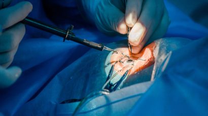 Economic Analysis of a Novel Graft Material for Ophthalmology – The Electrospinning Company